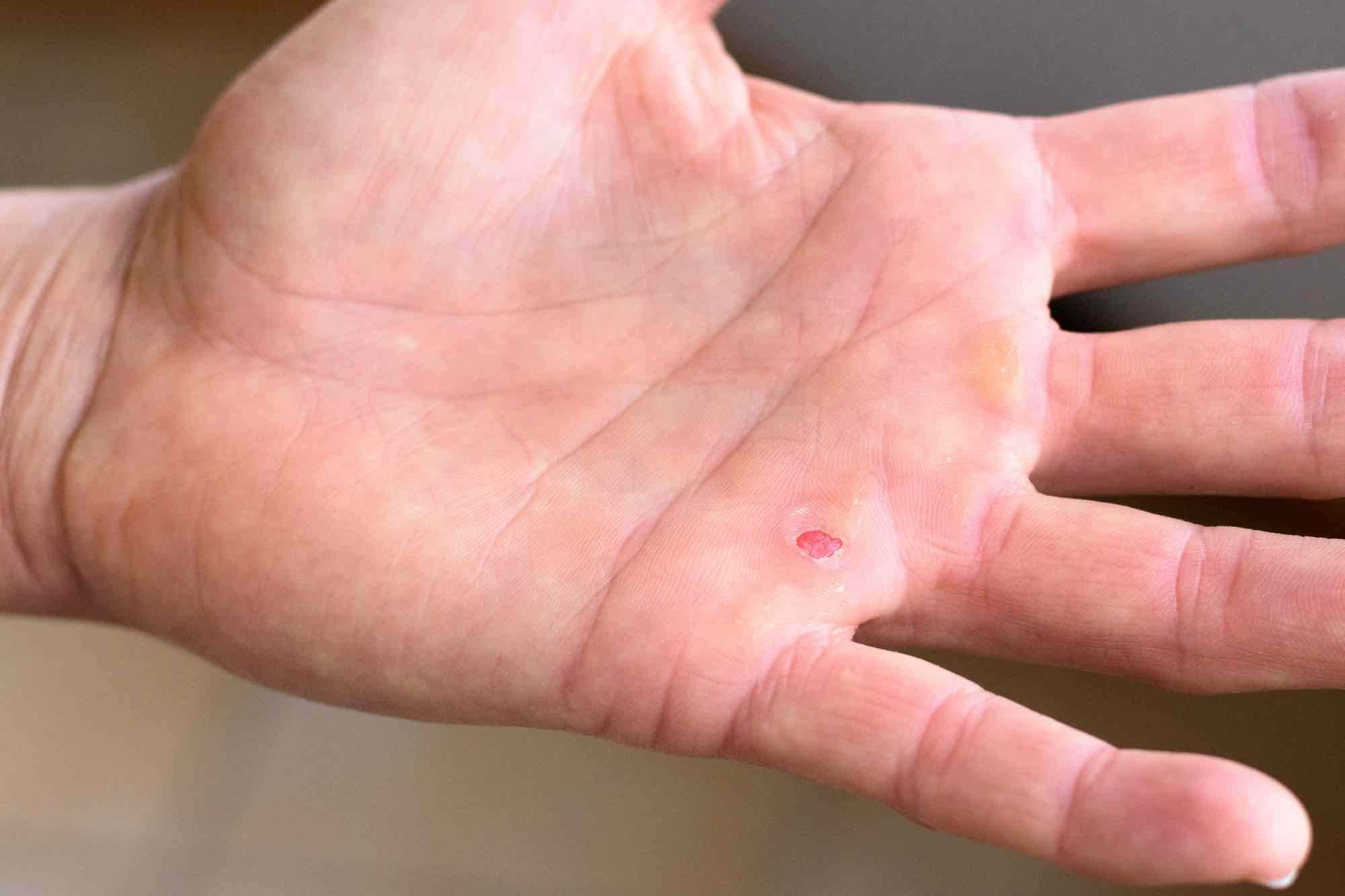 Wat Is Een Blaar & Wat Kun Je Er (Zelf) Tegen Doen? Pedicure.nl Wat Is Een Blaar & Wat Kun Je Er (Zelf) Tegen Doen? Pedicure.nl