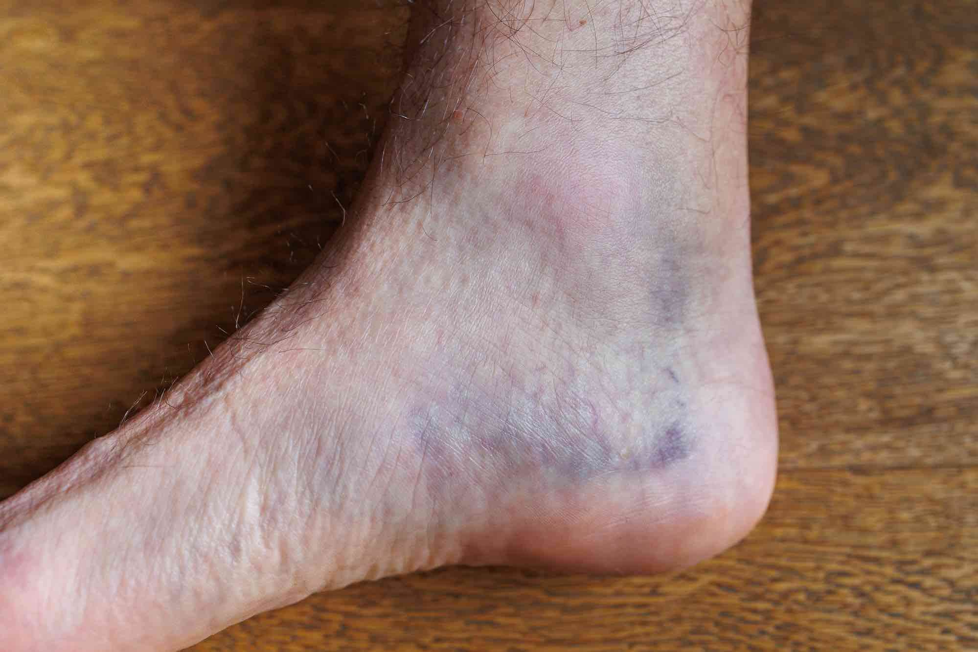 Verbonden jazz bewijs Wat zijn blauwe of paarse voeten en/of tenen en wat kun je er tegen doen?
