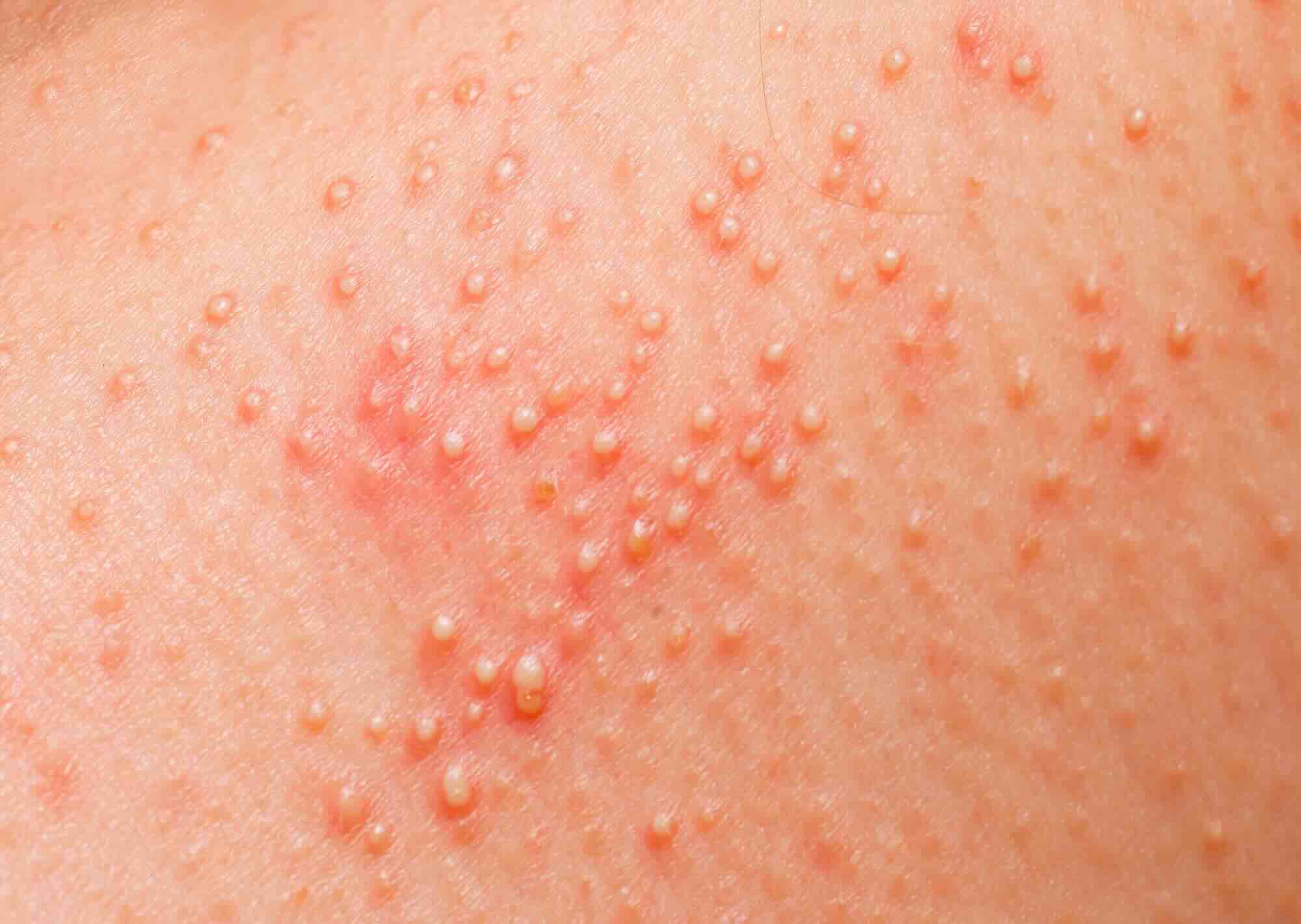 voorbeeld van allergische reactie, mogelijk warmte-uitslag in de vorm van warmtebultjes, op huid