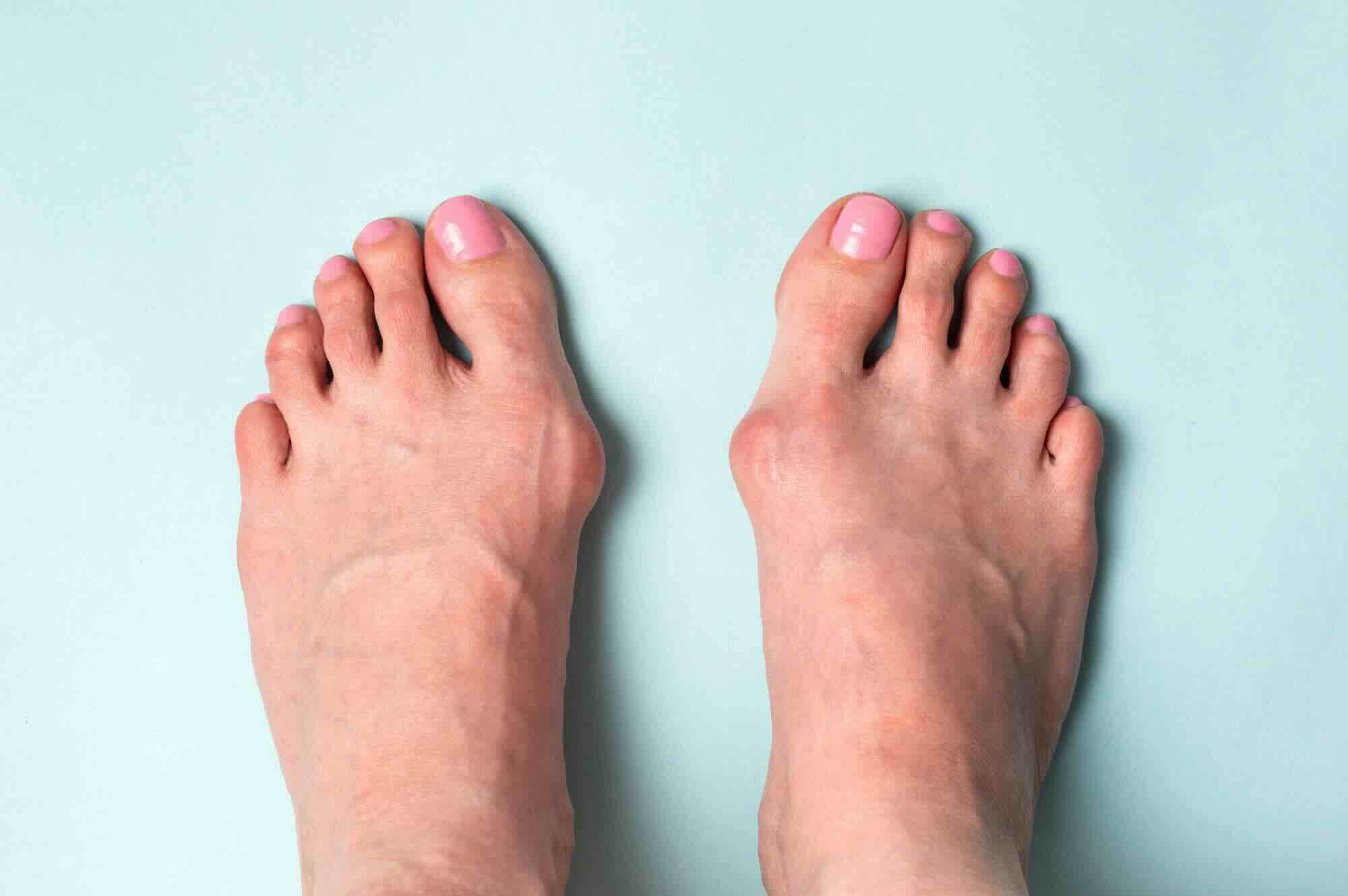 Hallux valgus