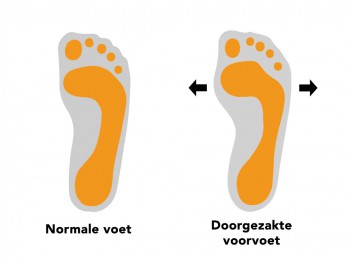 Wat is een doorgezakte voorvoet (spreidvoet) en wat kun je er (zelf) tegen doen?