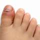 Wat is een nagelriemontsteking en wat kun je er (zelf) tegen doen?