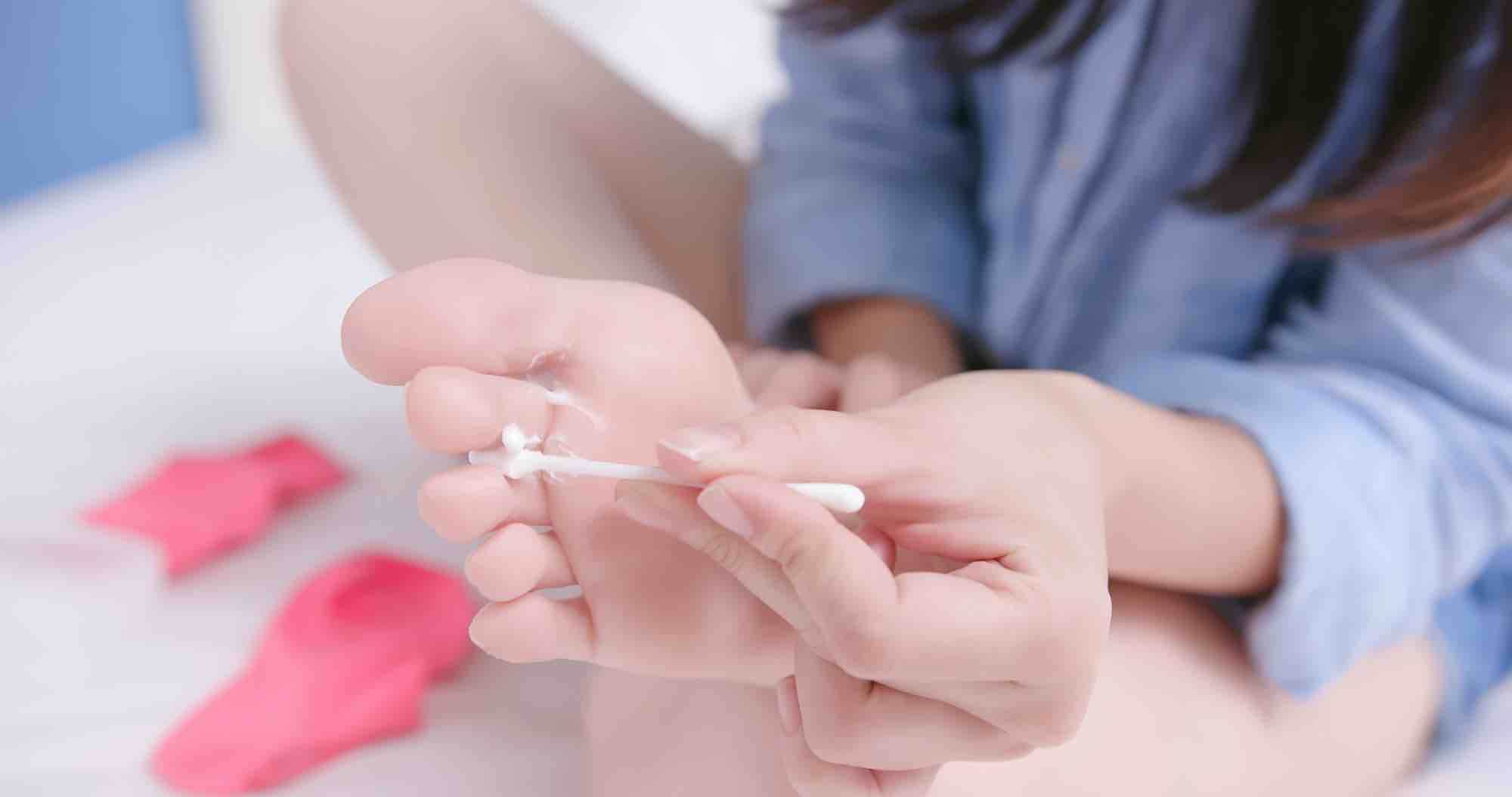 creme op voetschimmel tussen tenen