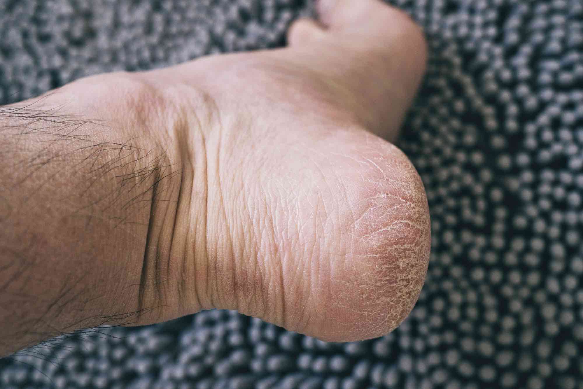 Knooppunt formaat naakt Wat zijn droge voeten en wat kun je er tegen doen?
