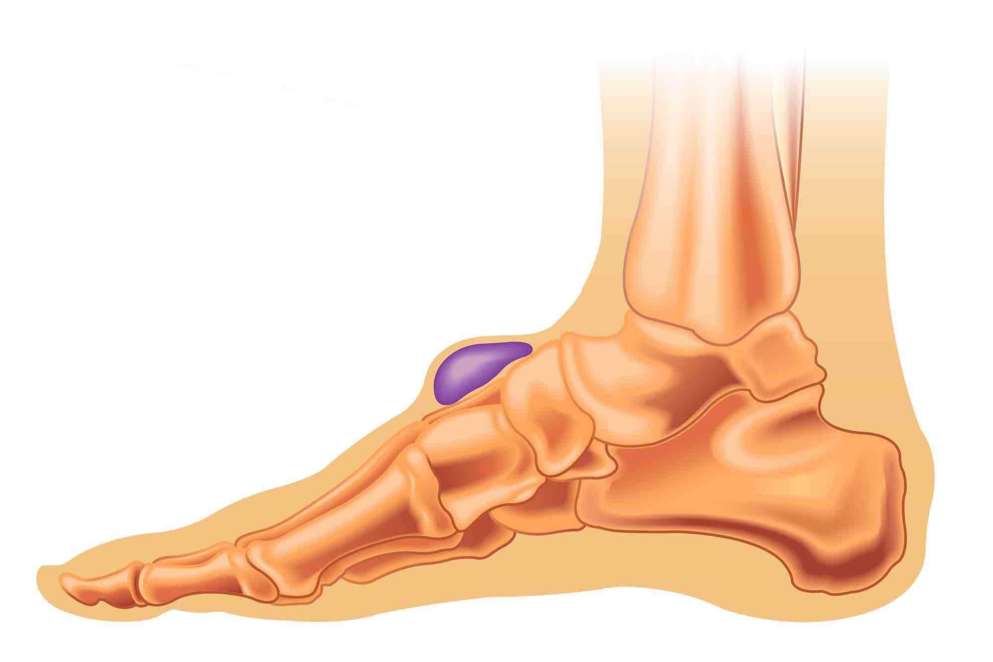 ganglion voet
