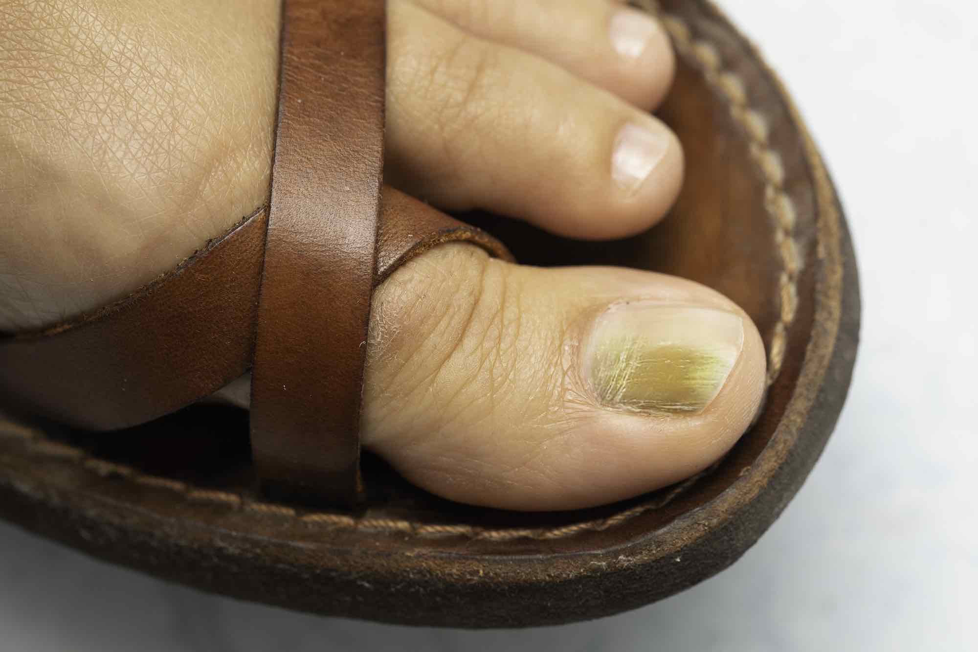 Gele teennagels behandelen, wat kun je er zelf tegen doen?