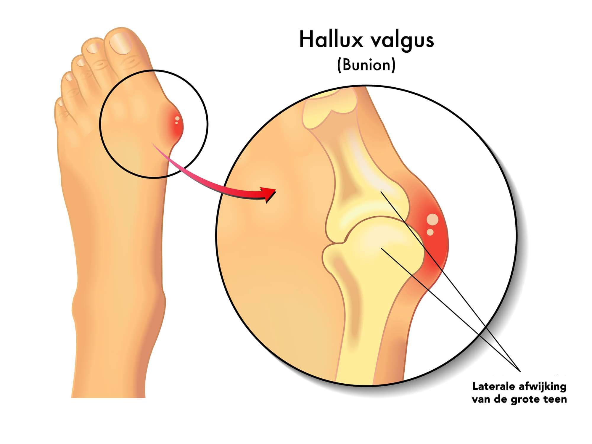 Tekening van halux valgus en bunion