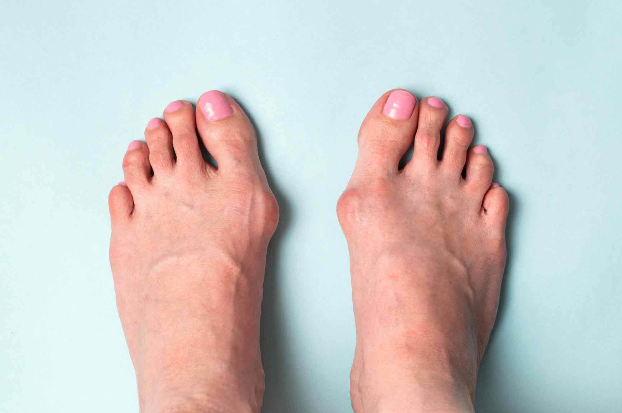 hallux valgus vrouw voet