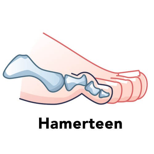 hamerteen