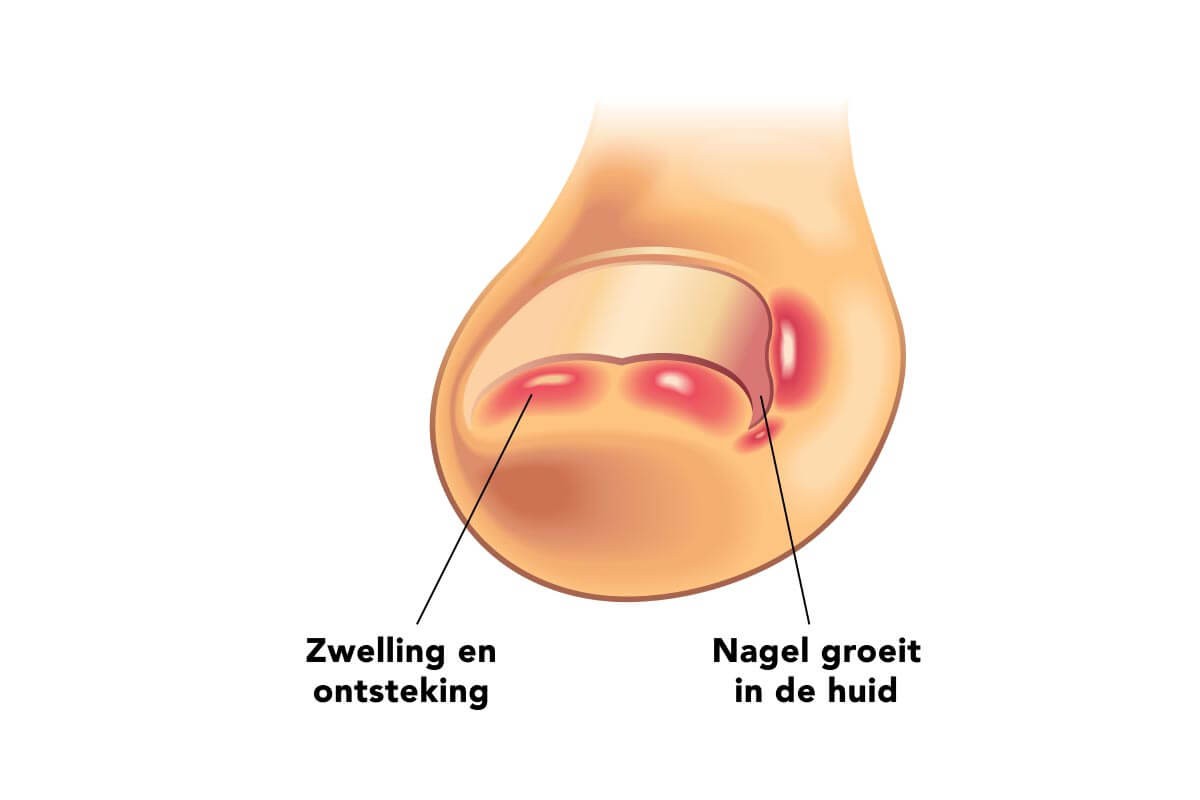 ingegroeide teennagel