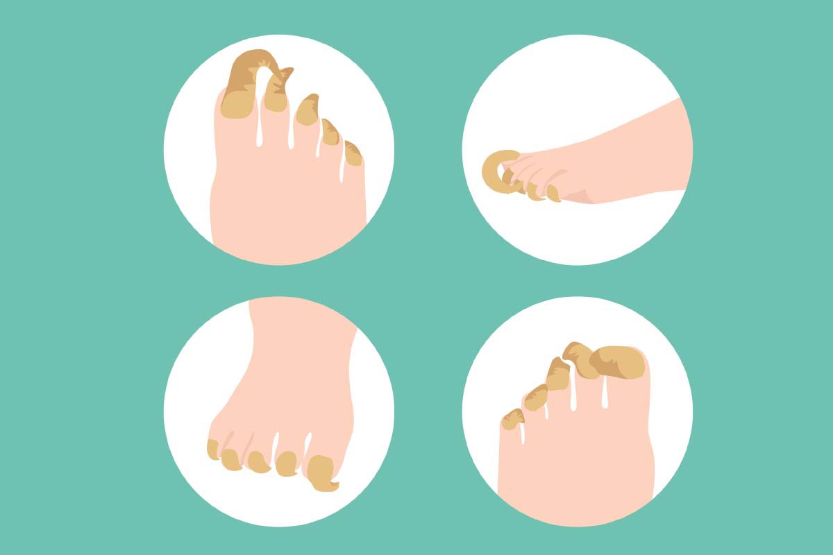 klauwnagel ramshoornnagel