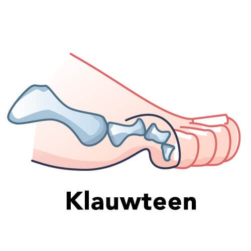 klauwteen