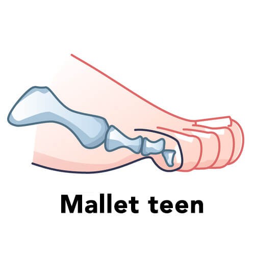 mallet teen