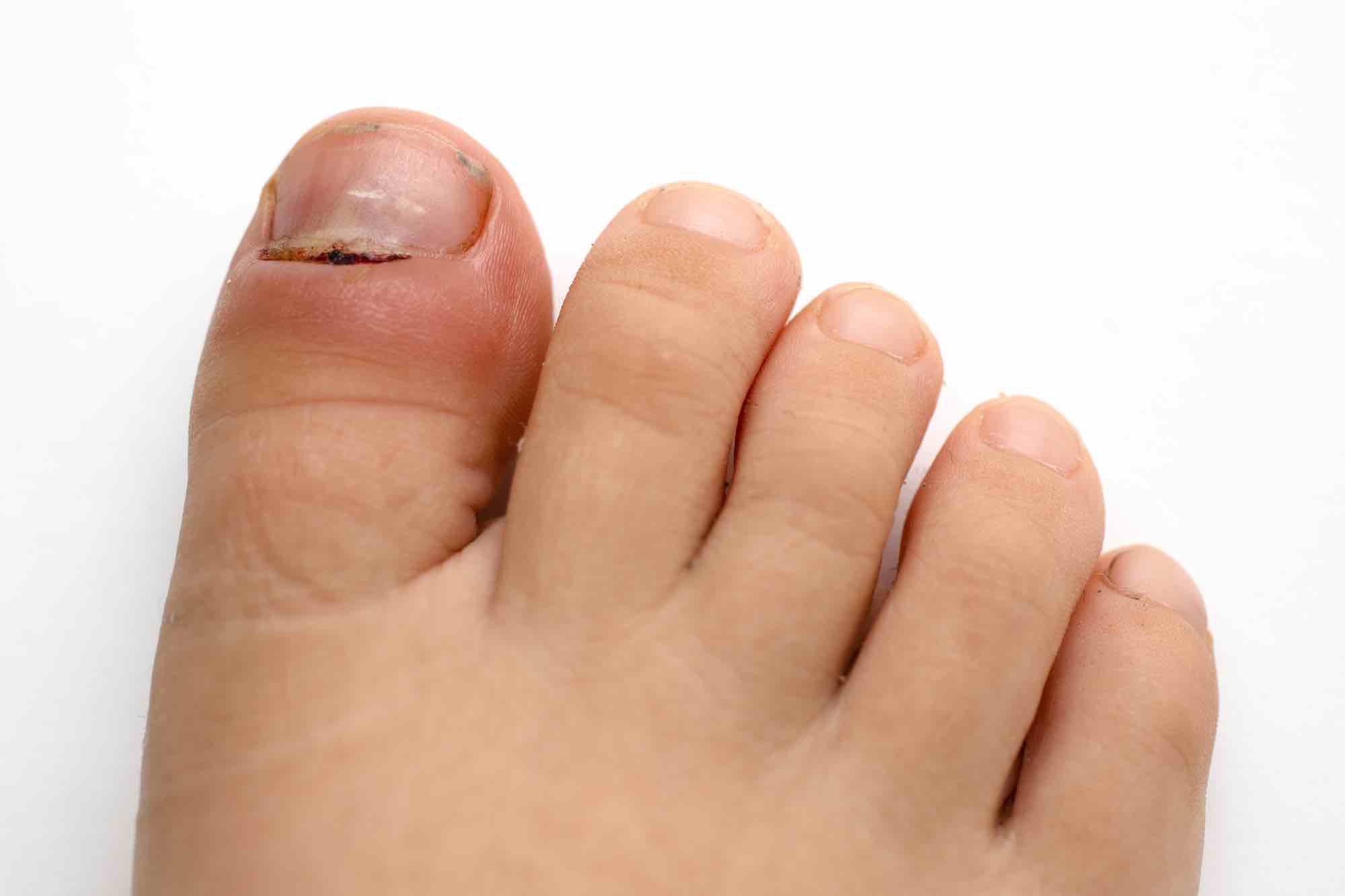 nagelriemontsteking paronychia