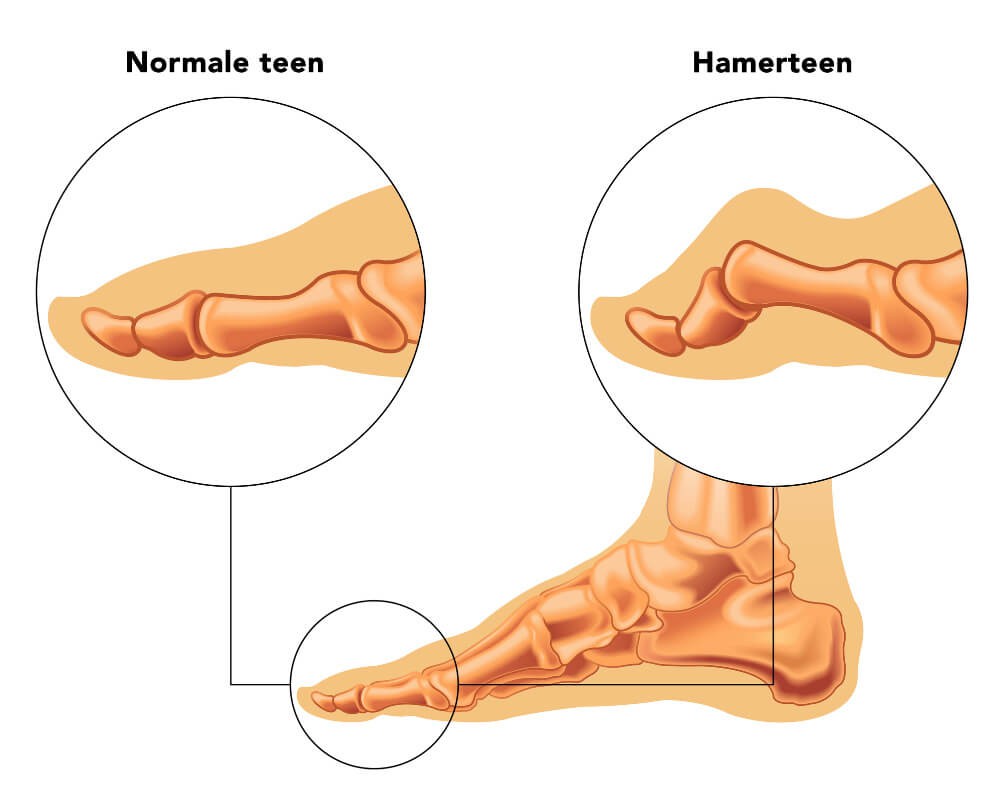 hamerteen normale teen