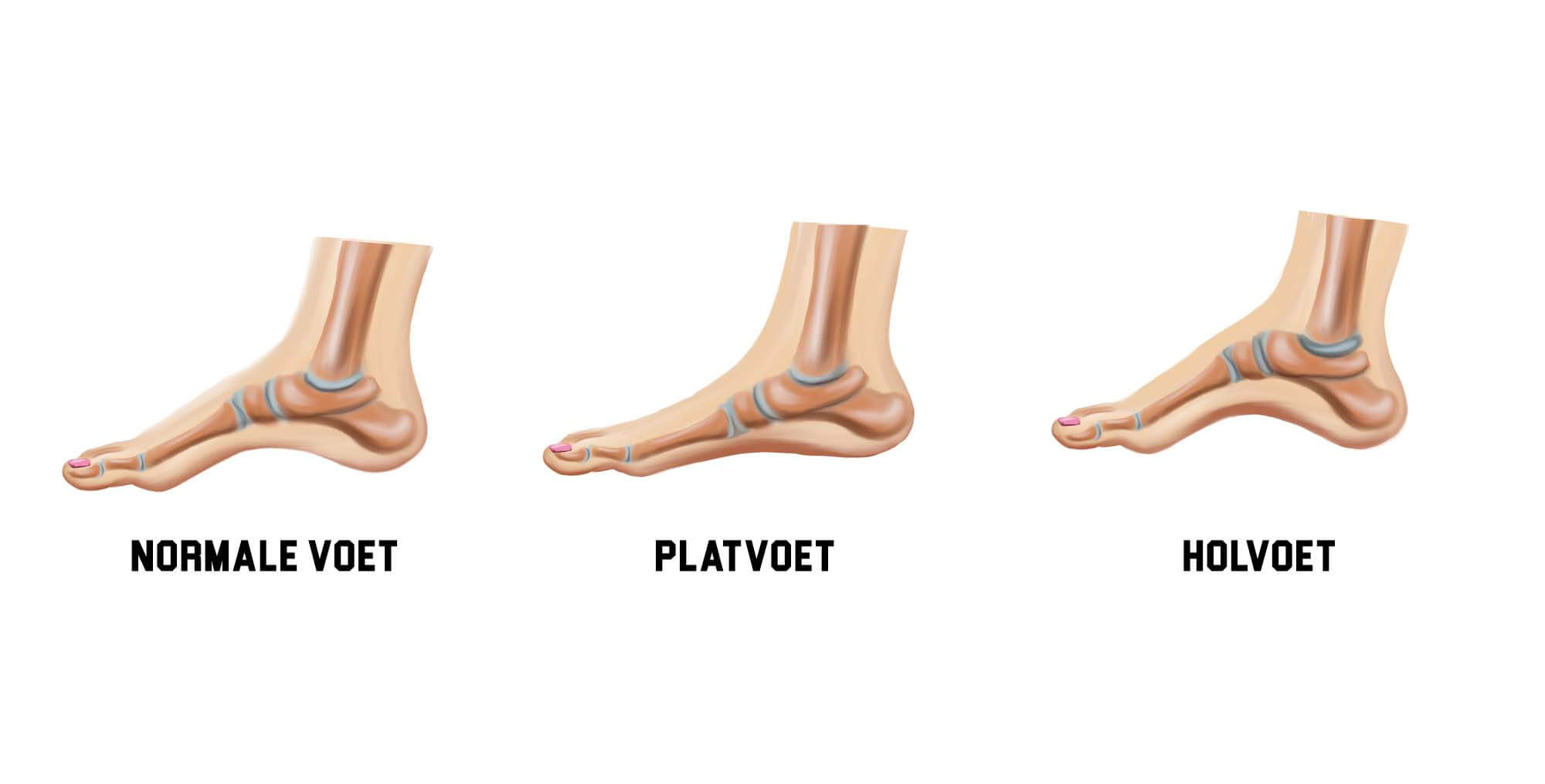 normale voet, platvoet, holvoet