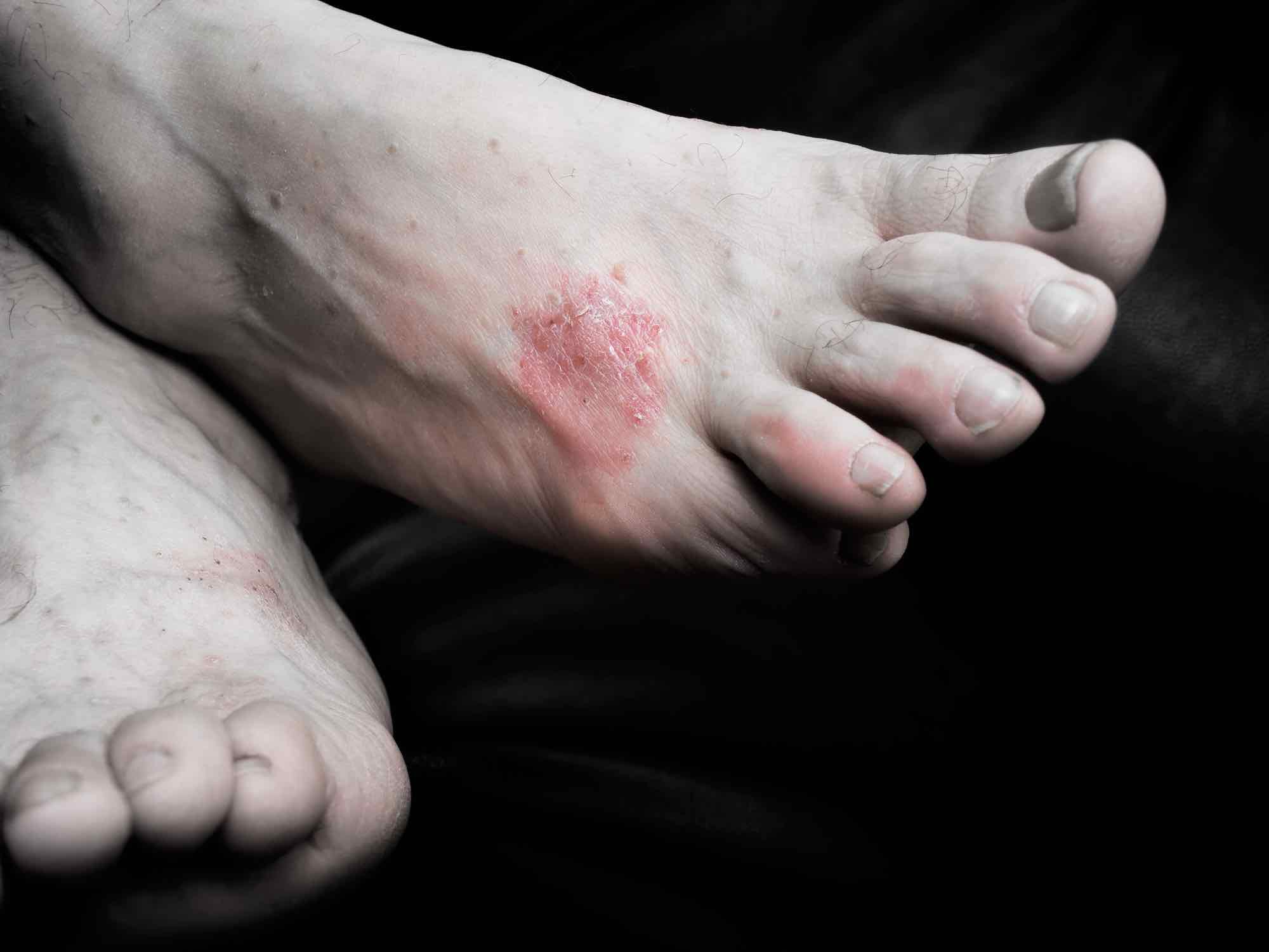 Jeukende voeten veelvoorkomende oorzaken van jeuk aan en onder de voet