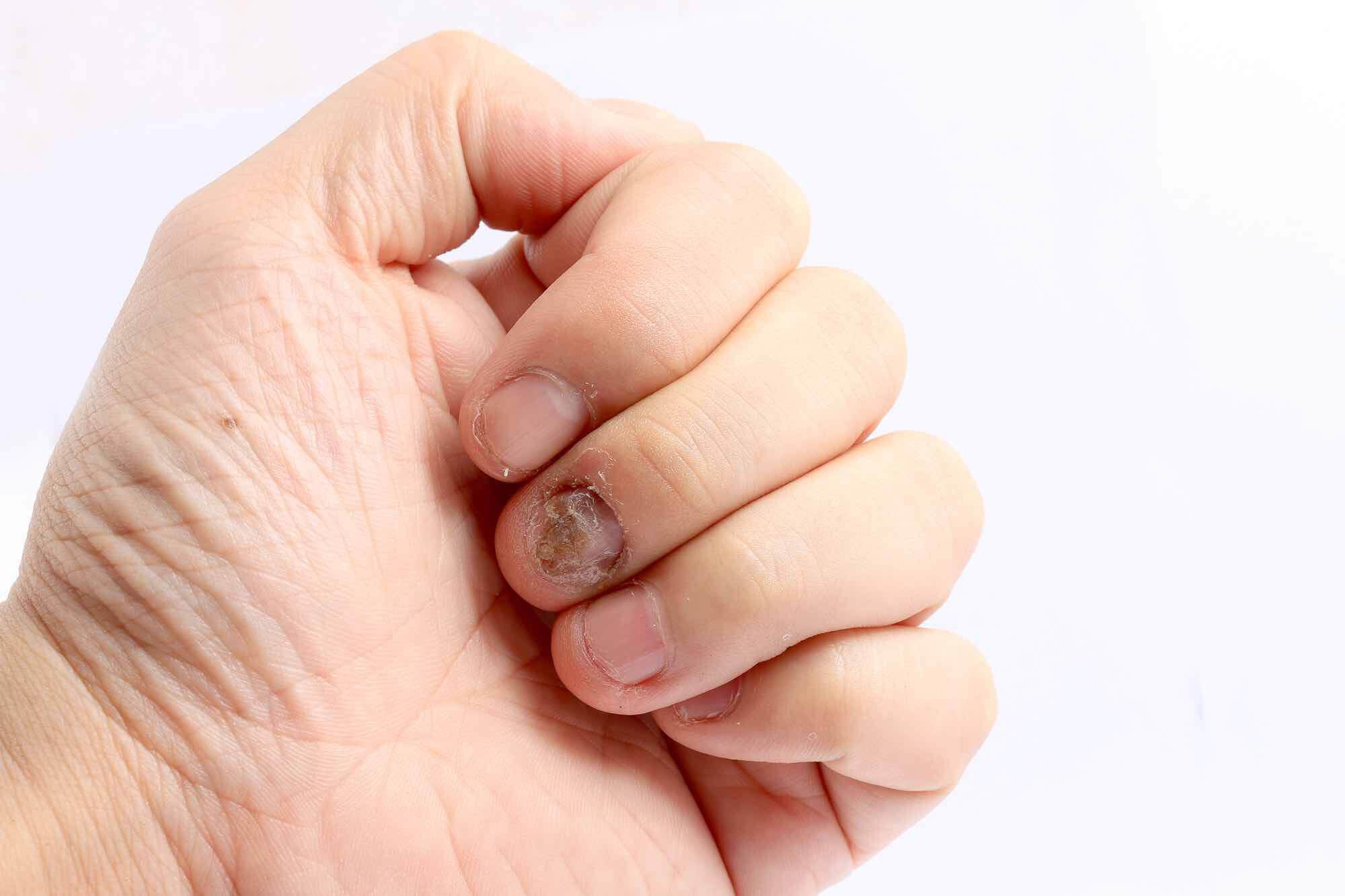 Schimmelnagel Kalknagel vinger