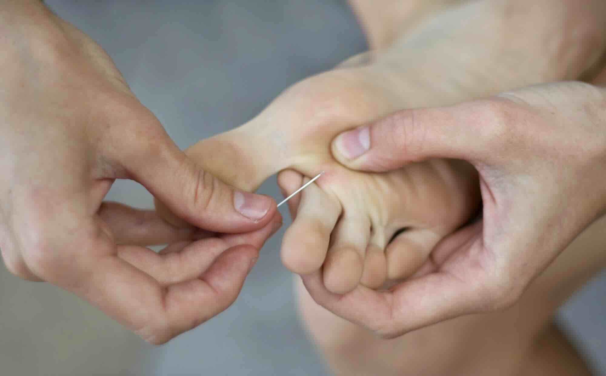 splinter verwijderen voet met naald