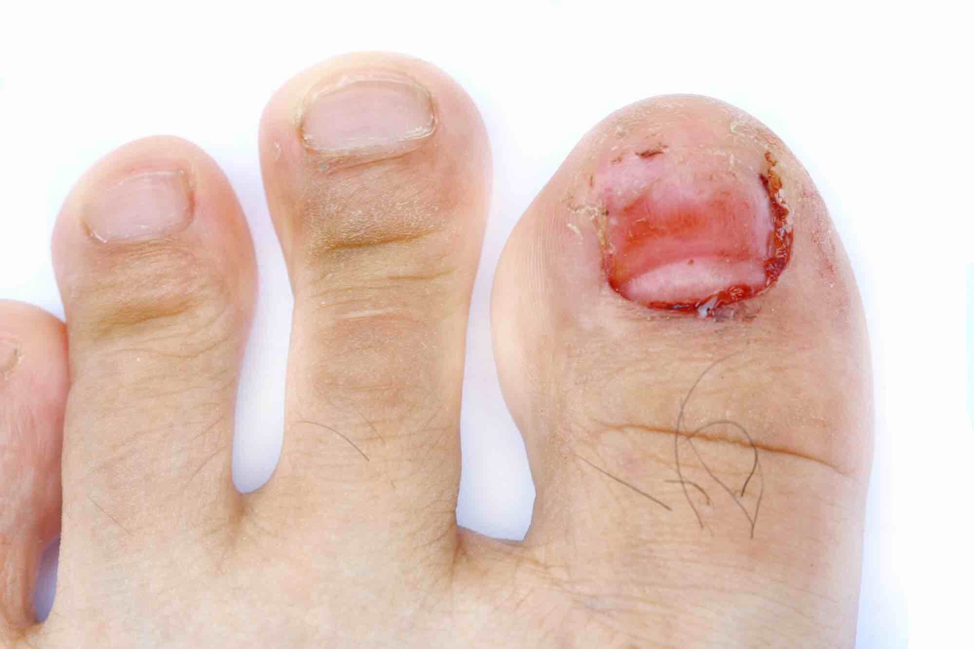 losgelaten teennagel