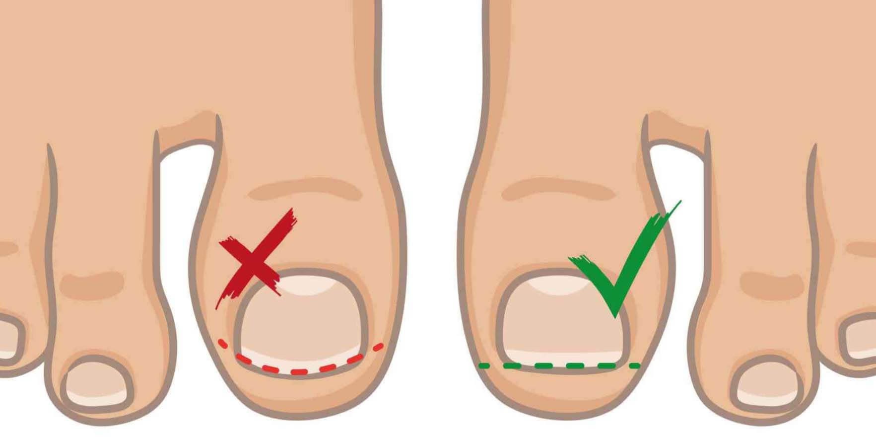 Teennagels Knippen | Kalk-, Schimmel- & Ingegroeid | Pedicure.nl