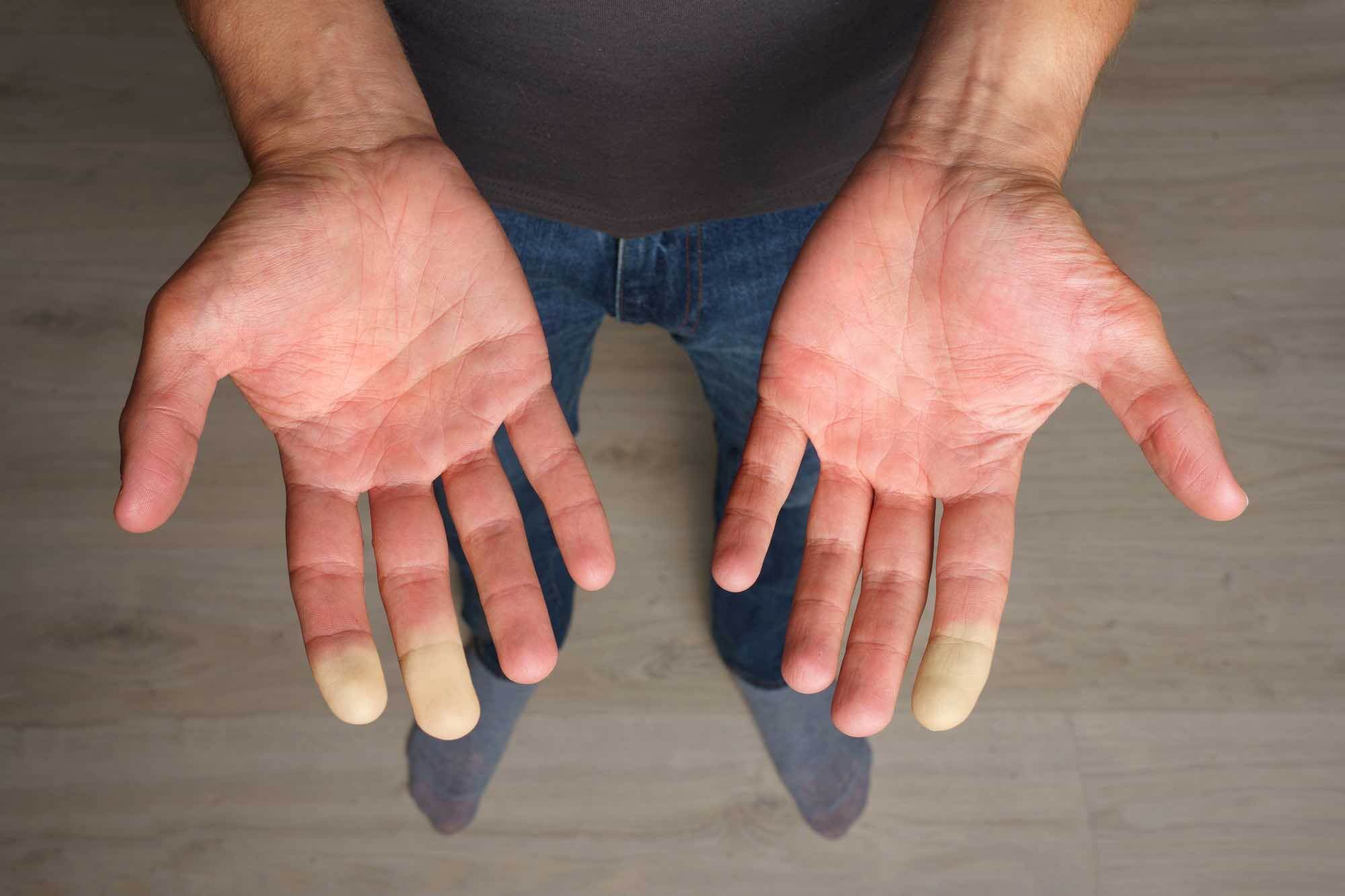 Raynaud vingers