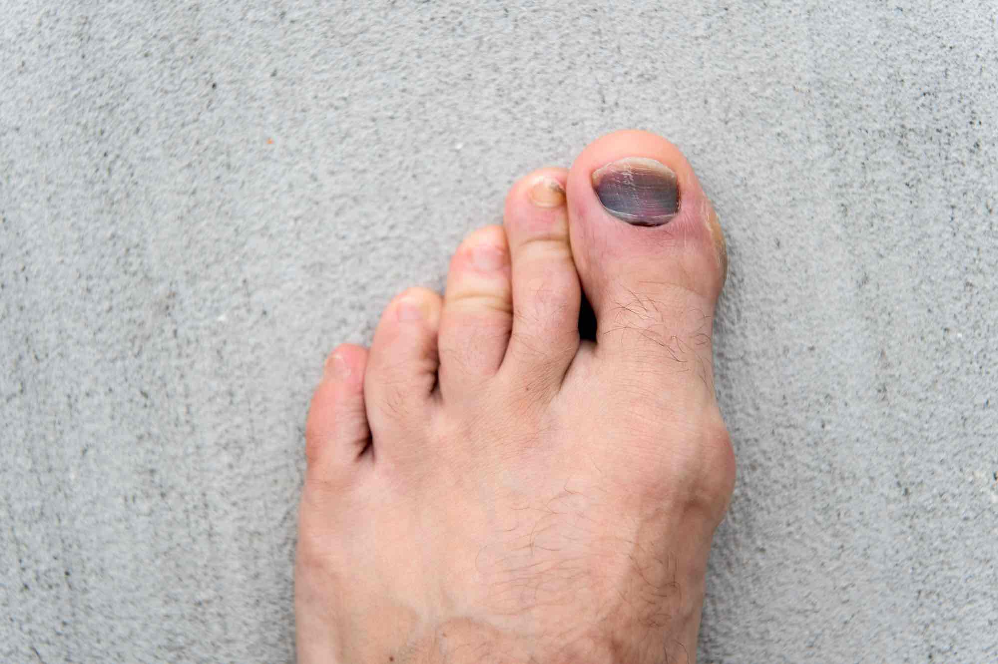 zwarte donkere teennagel grote teen