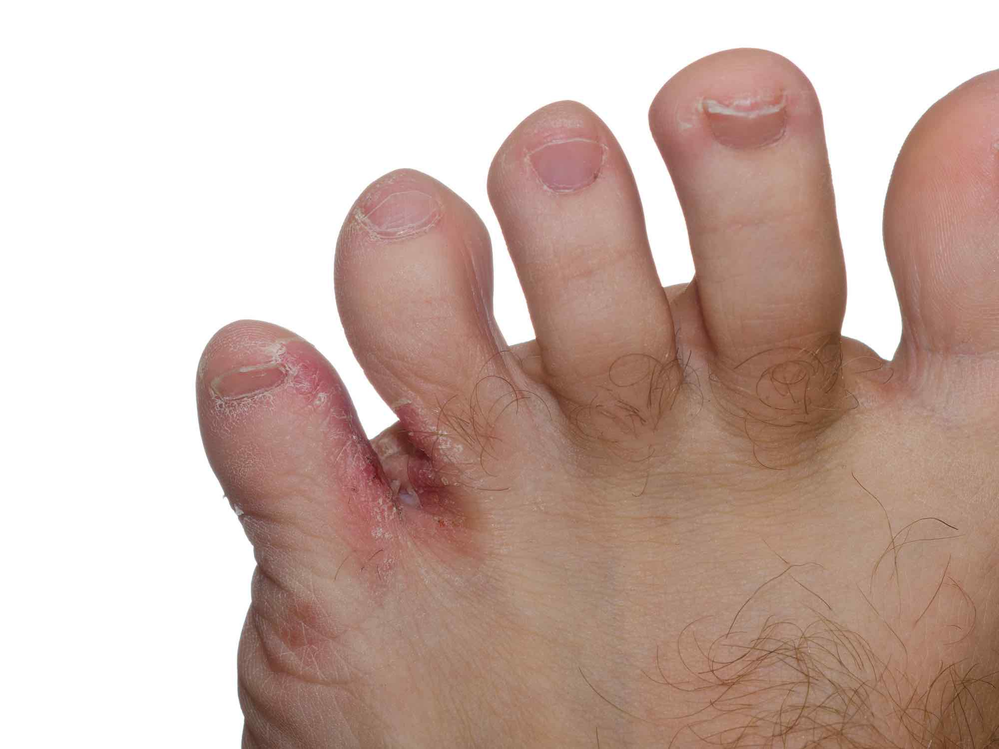 Jeukende veelvoorkomende oorzaken van jeuk aan en de voet